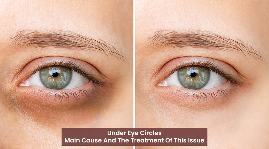 Under Eye Circles: Main Cause And The Treatment