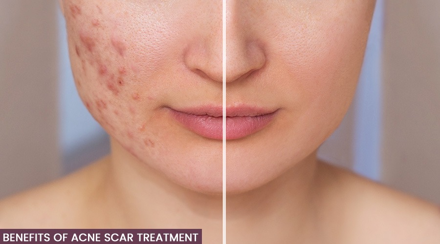 Benefits of Acne Scar treatment