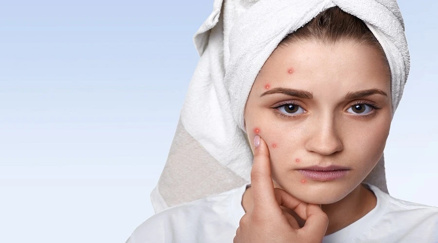 Acne Scarring: Treatment Option For Smoother Skin 