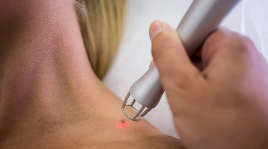 SKIN TAG REMOVAL:  A perfect guide to understanding the whole 