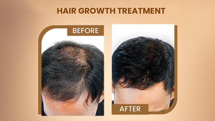Hair Fall Treatment